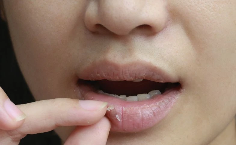 Featured Post Image - Mengatasi Bibir Kering dan Pecah-Pecah dengan Cara Mudah dan Tepat