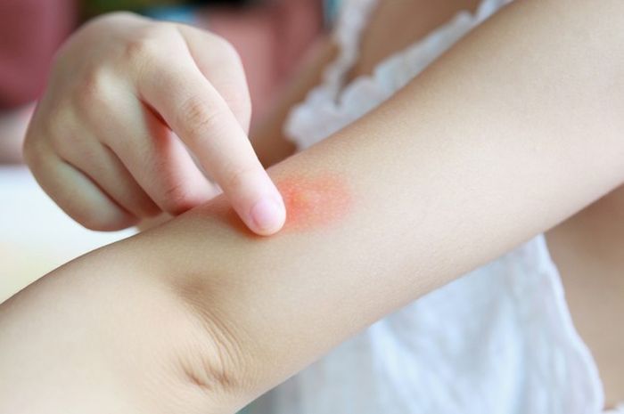Featured Post Image - Cara Menghilangkan Bekas Gigitan Nyamuk Paling Manjur